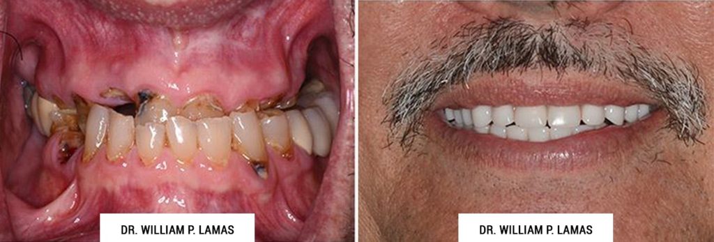 All-on-4 Dental Implants Before & After Photo - William P. Lamas, DMD - Periodontics & Dental Implants. Address: 2645 SW 37th Ave Suite 304, Miami, FL 33133 Phone: (305) 440-4114