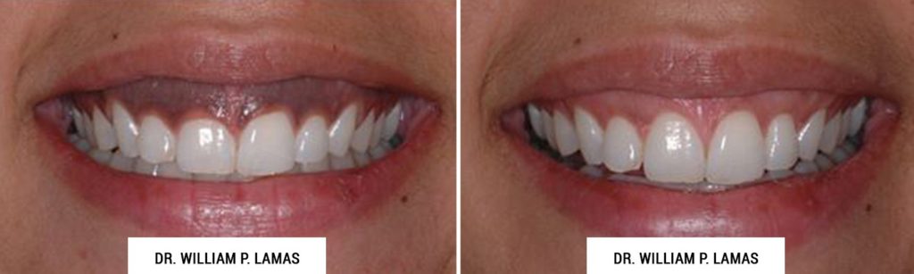Dark Gum Depigmentation Before & After Photo - William P. Lamas, DMD - Periodontics & Dental Implants. Address: 2645 SW 37th Ave Suite 304, Miami, FL 33133 Phone: (305) 440-4114