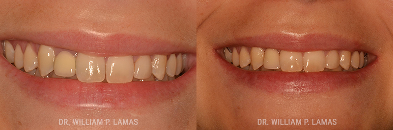Gum Grafting Treatment Before & After Photo - William P. Lamas, DMD - Periodontics & Dental Implants