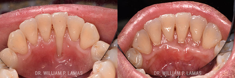 Gum Grafting Treatment Before & After Photo - William P. Lamas, DMD - Periodontics & Dental Implants
