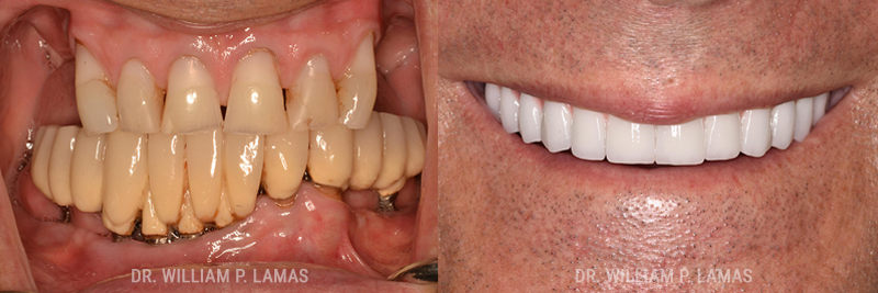 All-on-4 Dental Implants Before & After Photo - William P. Lamas, DMD - Periodontics & Dental Implants.