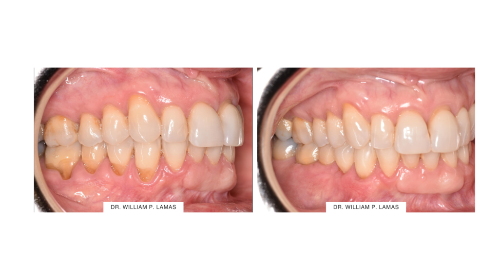 Gum Recession Treatment (Gum Grafting) Before & After