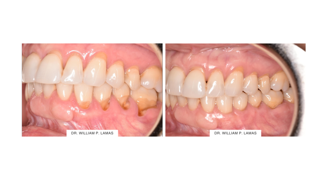Gum Recession Treatment (Gum Grafting) Before & After